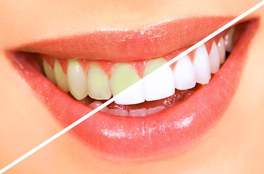 Szebb és fehérebb fogak akár 30 perc alatt - PREMIUM DENTAL fogászat, Budapest